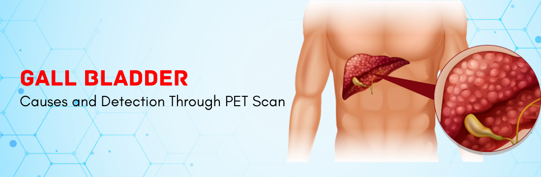 Gall Bladder Cancer Detection Through PET CT Scan